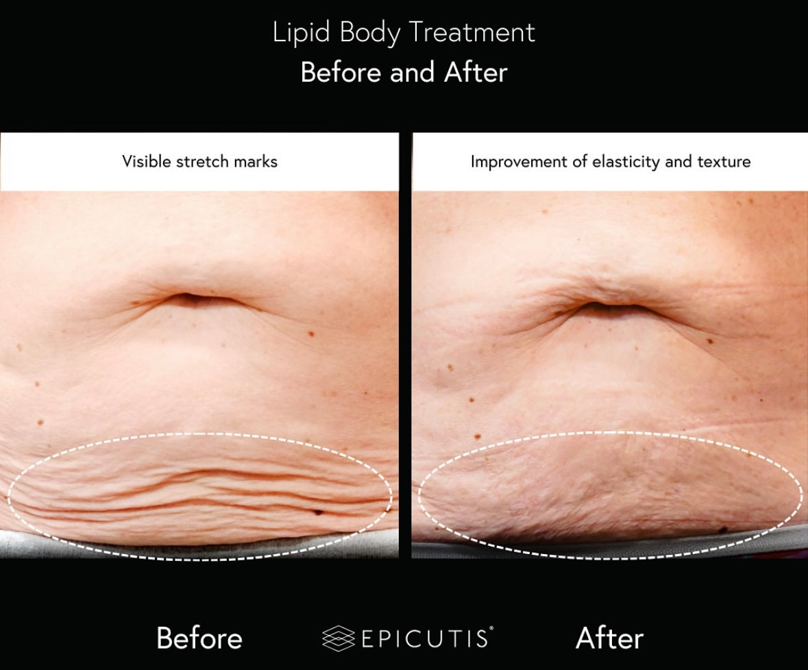 Epicutis Lipid Body Treatment