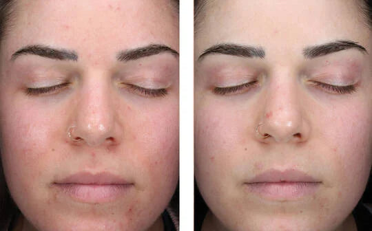 PRE ORDER Skinbetter Alpharet Clearing Serum