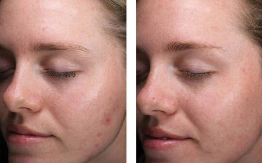 PRE ORDER Skinbetter Alpharet Clearing Serum