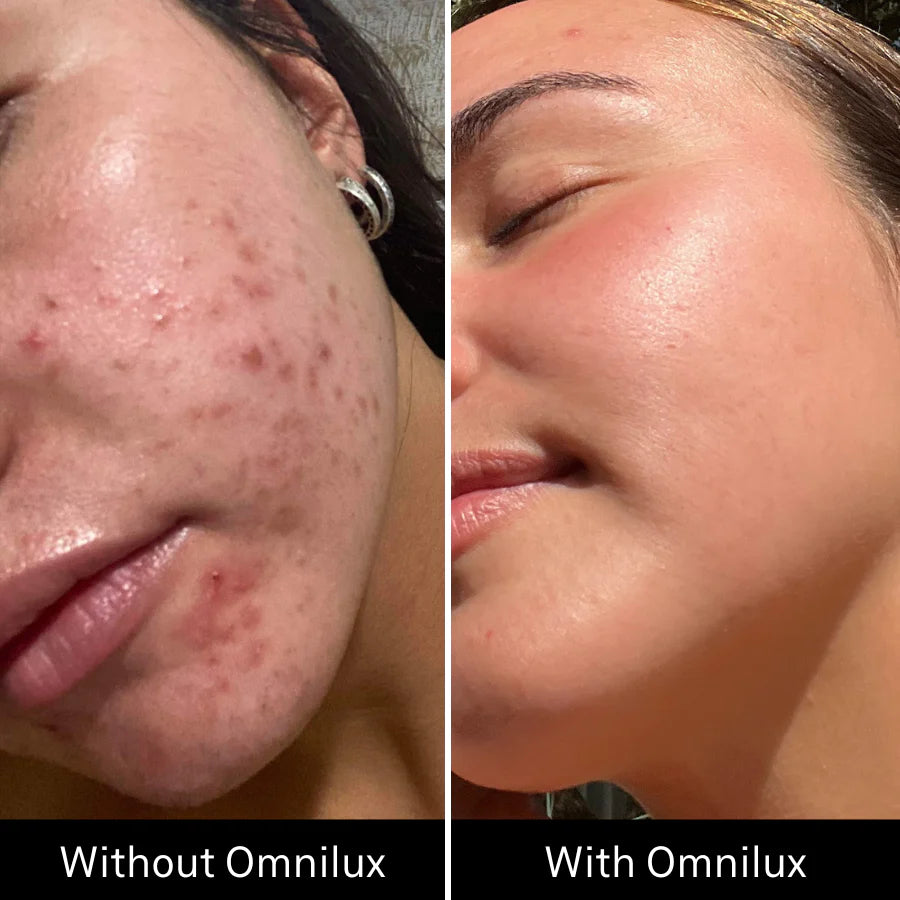 Omnilux Clear LED Face Mask (Acne)