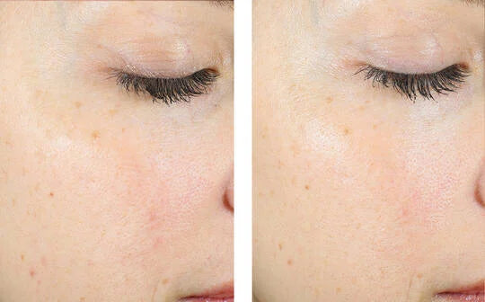 Skinbetter AlphaRet Exfoliating Peel Pads