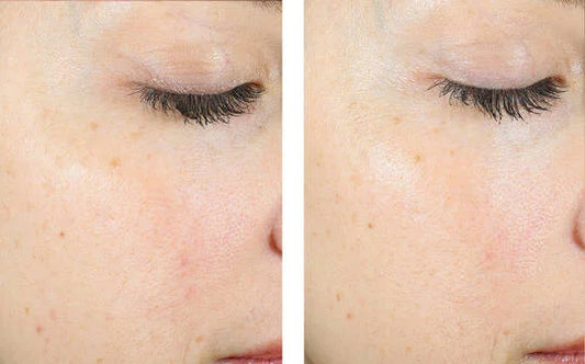 Skinbetter AlphaRet Exfoliating Peel Pads