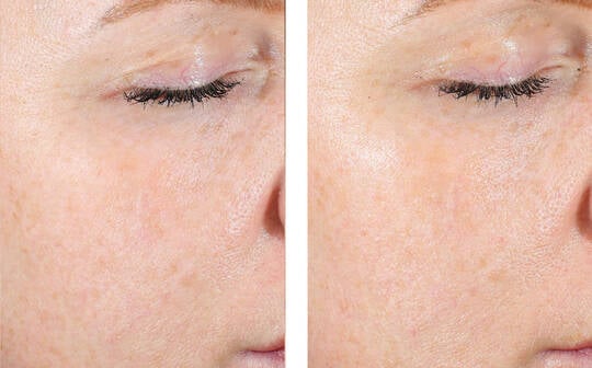 Skinbetter AlphaRet Exfoliating Peel Pads